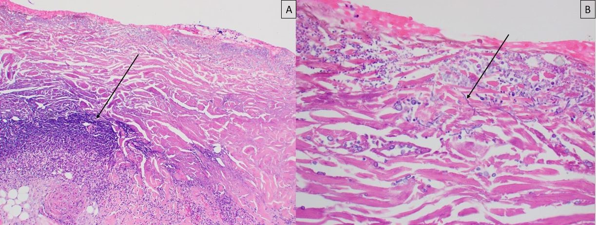 ecthyma gangrenosum histology