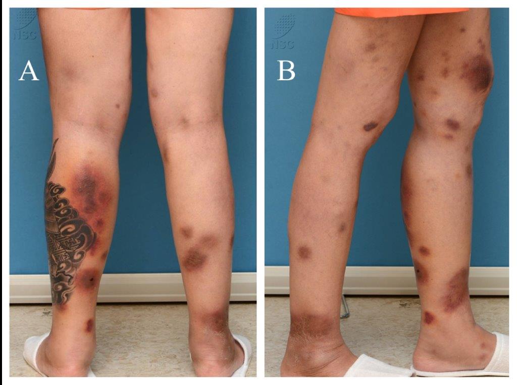 Erythematous nodule with central hole on the inferior middle third of