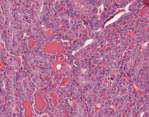 Noninvasive follicular thyroid neoplasm with papillary-like nuclear features and the risk of malignancy in thyroid cytology: Data from Singapore