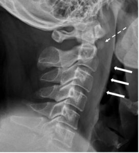 Neck pain with prevertebral soft tissue thickening - Annals Singapore