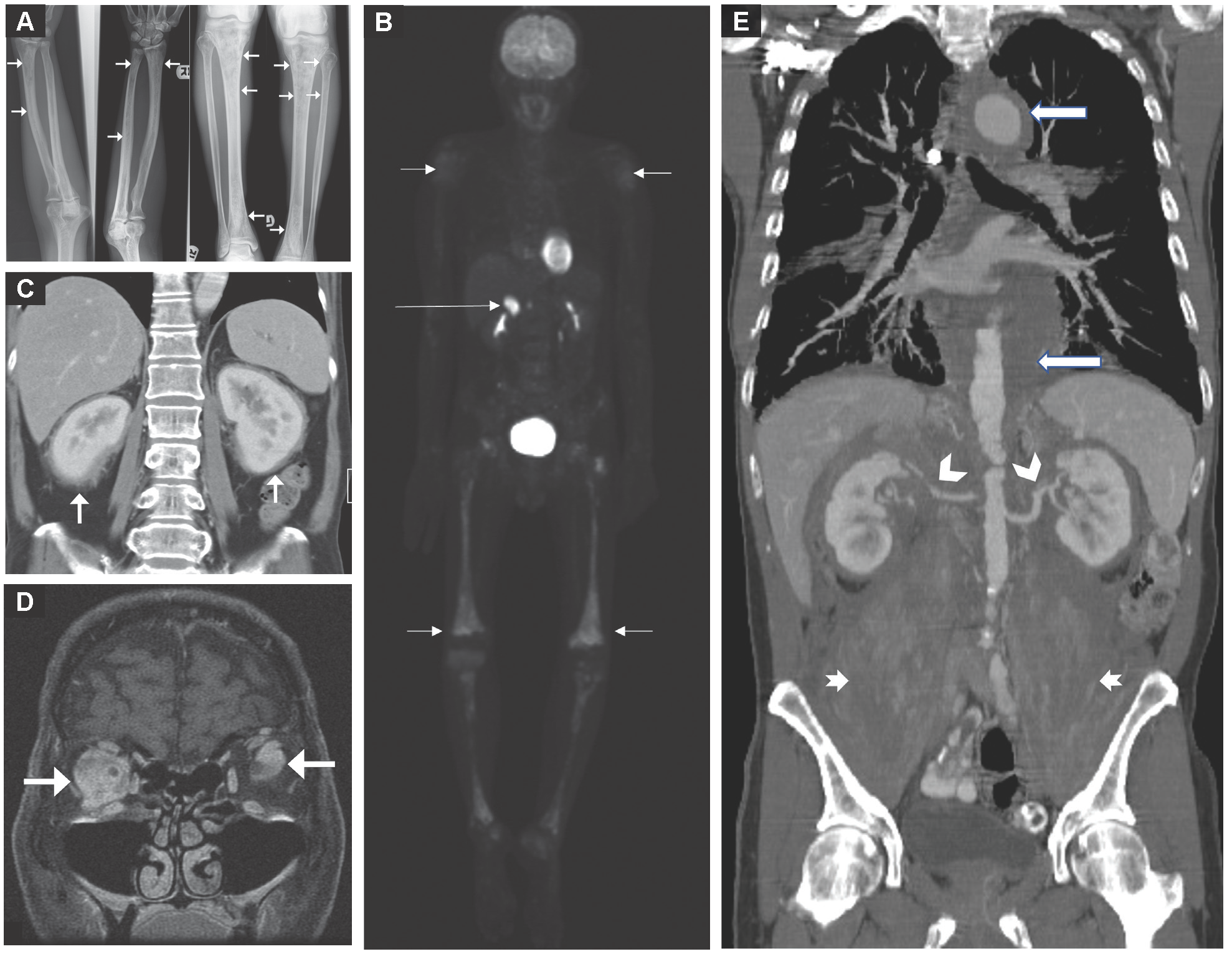 Erdheim-Chester Disease: Imaging Spectrum Of Multisystemic ...