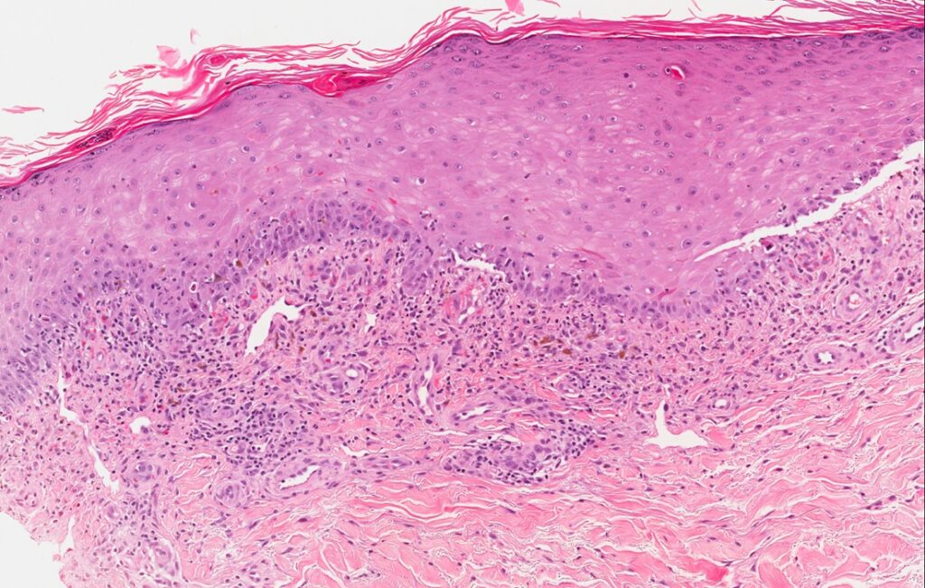 Lichen planus pemphigoides after pembrolizumab immunotherapy in an ...