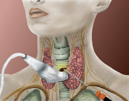 The efficacy and safety of radiofrequency ablation in papillary thyroid carcinoma: A systematic review and meta-analysis