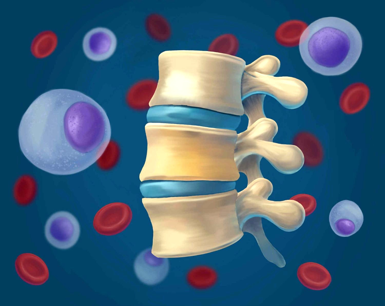 Singapore Myeloma Study Group consensus guidelines for the management of  patients with newly diagnosed multiple myeloma - Annals Singapore
