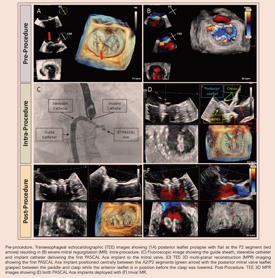 Multipanel image demonstrating Transcatheter Edge-to-Edge Repair (TEER) with the PASCAL system. Pre-procedure TEE shows posterior mitral valve leaflet prolapse and severe regurgitation (A-B). Intra-procedure images show fluoroscopy of the PASCAL Ace implant delivery (C) and 3D TEE multi-planar reconstruction (MPR) confirming leaflet grasping (D). Post-procedure TEE 3D MPR shows both PASCAL Ace implants deployed with trivial residual MR (E-F).