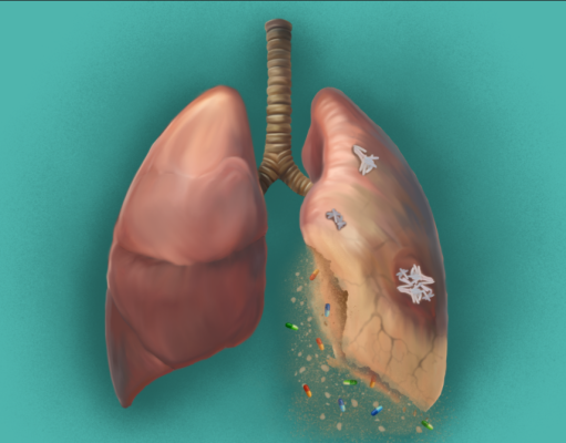 Treatment outcomes in Mycobacterium abscessus pulmonary disease: A systematic review
