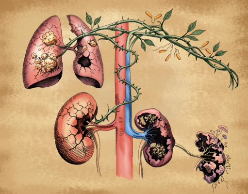 Incidence and risk factors for tuberculosis in patients with chronic kidney disease in Singapore