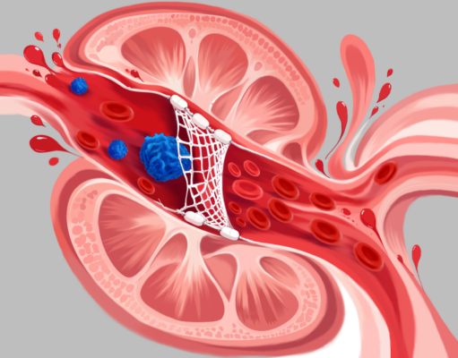 A randomised controlled study of canagliflozin in improving diabetic kidney disease through a podocyte protection mechanism
